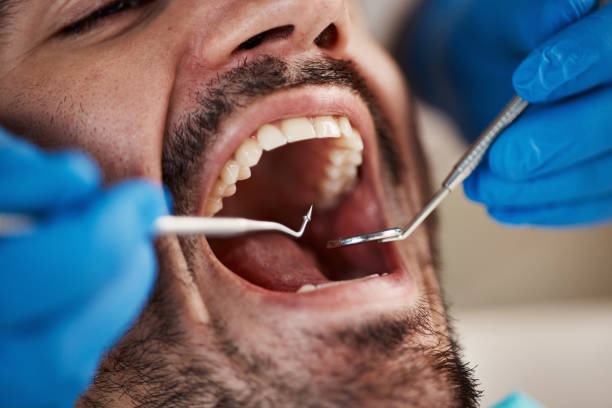 Best Emergency Gum Treatment in Selma, TX